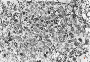  F,69y. | urinary bladder - malakoplakia